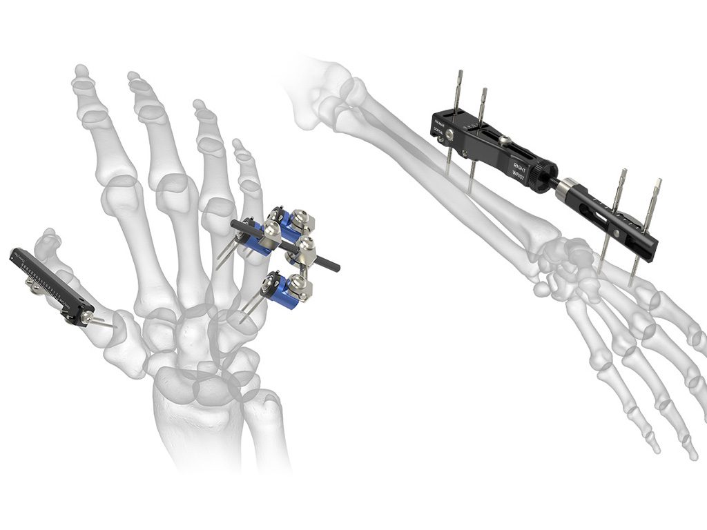 External Fixators Market