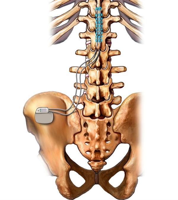 Spinal Cord Stimulation Market Emerging Trend and Global Demand 2024 to 2031 